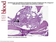 First needle marrow biopsy to diagnose a systemic illness