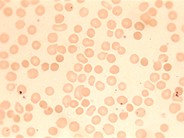 Red Blood Cell Diseases (RBC) 1 - 4.