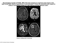 Neuroimaging example of PCNSL