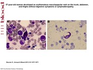 Systemic mastocytosis