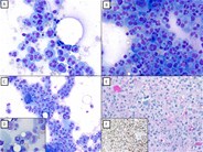 Plasma Cell Myeloma with Sarcomatoid Morphology