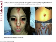 Hematidrosis: blood sweat