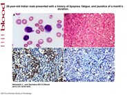Unusual hairy cell projections in hepatosplenic T-cell non-Hodgkin lymphoma