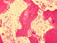 Untreated chronic renal failure