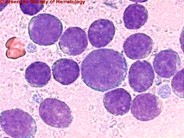 Acute Biphenotypic Leukemia - 3.