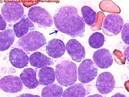 Acute Biphenotypic Leukemia - 4.