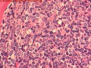 Acute Biphenotypic Leukemia - 5.
