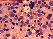 Acute Biphenotypic Leukemia - 7.