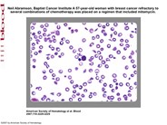 Drug-associated thrombocytopenia and anemia