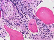 Bone marrow sarcoidosis - 2