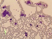 platelet clump in peripheral blood smear