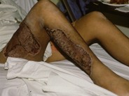 Postvaricella purpura fulminans - 2.