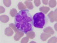 ALK-negative anaplastic large cell lymphoma, leukemic phase