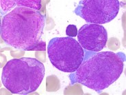 Paediatric acute promyelocytic leukemia with a tetraploid karyotype