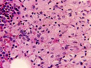 Gaucher's Disease - 1(c).