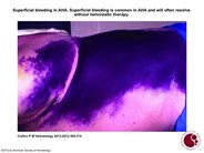 Superficial bleeding in AHA