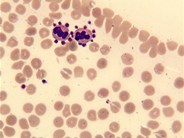 Pseudothrombocytopenia due to platelet satellitism