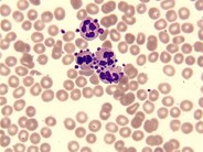 Pseudothrombocytopenia due to platelet satellitism