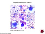 Acute leukemia and precursor neoplasms.