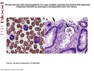 Colonic graft-versus-host disease (GVHD) manifesting as eosinophilic colitis following autologous hematopoietic stem cell transplantation