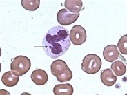 Neutrophil - Nuclear Appendages - 3.