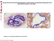 Concomitant microfilaria and malaria infection