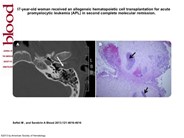 Acute promyelocytic leukemia presenting as a mass in the external ear
