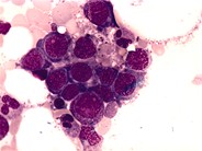 Megaloblastic Anemia - 1.