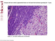 Collision of chronic lymphocytic leukemia/small lymphocytic lymphoma and melanoma