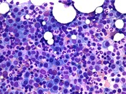 Multiple myeloma - Dutcher bodies