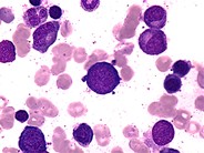 Megaloblastic Anemia - 6.