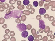 CLL - mixed cell type