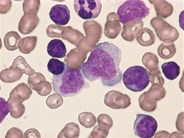 CLL - mixed cell type