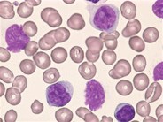 CLL - mixed cell type