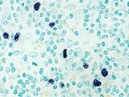 Angioimmunoblastic T Cell Lymphoma - 6.