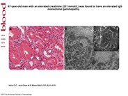 Light chain deposition