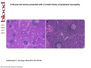 POEMS syndrome and Castleman disease