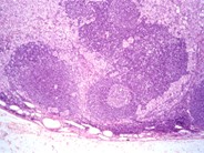 Metastatic Carcinoma - 1.
