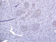 Autoimmune Lymphoproliferative Syndrome - 9.