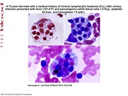 Hemophagocytosis in a patient with persistent chronic lymphocytic leukemia