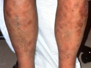 Subcutaneous Panniculitis-like T-cell Lymphoma - 1.