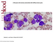Acute megakaryoblastic leukemia