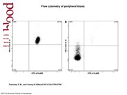 Paroxysmal nocturnal hemoglobinuria and its complications