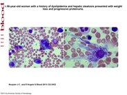 Auer rod-like inclusions in ? light chain myeloma