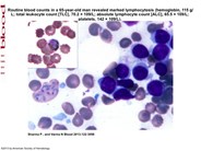 Pancytopenia following vivax malaria in a CLL patient