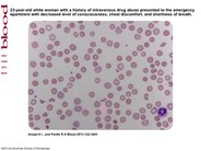 Opana-ER used the wrong way: intravenous abuse leading to microangiopathic hemolysis and a TTP-like syndrome