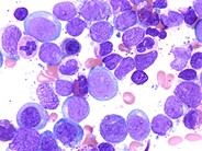 Blast-Crisis-of-CML--12