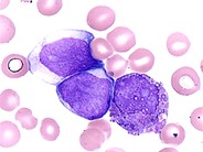 Blast-Crisis-of-CML--6