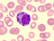 Melanin inclusions in the neutrophils of a patient  with metastatic melanoma.