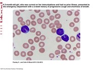 Peripheral smear clues for Bordetella pertussis